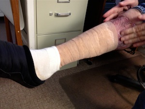 Leg of Flanders man who nearly died from an infection by a flesh-eating bacteria in December