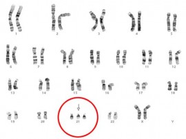2014_1012_karyotype-down-syndrome